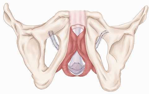 Post-prostatectomy Candidates for Transobturator Sling Surgery